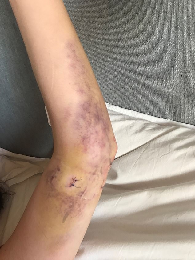 The acclaimed violinist arm following an operation on her elbow after the accident in 2019