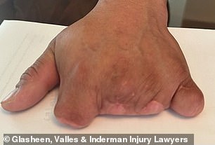 Gomez lost four fingers on his dominant left hand while operating a piece of kitchen equipment in July 2016